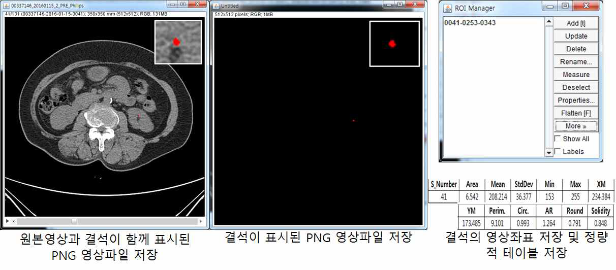 전용 요로결석 레이블링 소프트웨어 수행 결과