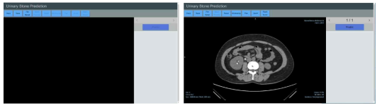 요로결석 자동판독 웹 애플리케이션 UI 구성