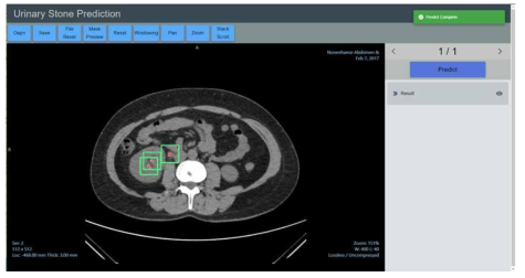 의료영상에서 요로결석 진단 영역에 대한 히트맵 수행 결과