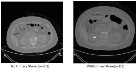 Urinary stone Disease Dataset 과 Normal Dataset