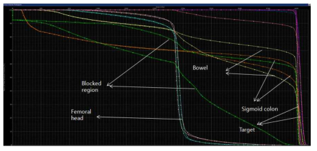 Aperture & Block 다층구조 IMRT (triangle) 와 3D 입체조형방사선치료 (box) 의 dose-volume histogram (DVH) 비교. 자동구획 IMRT 의 결과에서 타겟선량의 coverage 와 homogeneity 가 개선되는 효과를 보이며, block 의 추가로 blocked region에서 전달선량이 현격하게 감소되는 것을 확인할 수 있음. 이러한 선량 감소는 주변에 분포하고 있는 bowel, sigmoid colon 등의 선량을 감소시키는 효과를 가져옴