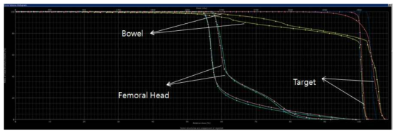 통상적 3D 입체조형 방사선 치료 (Box) 와 자동구획 IMRT (Triangle) 의 dose-volume histogram (DVH) 비교. 타겟 영역의 coverage 와 homogeneity 가 자동구획 IMRT 치료에서 현격히 개선되는 것을 확인할 수 있음
