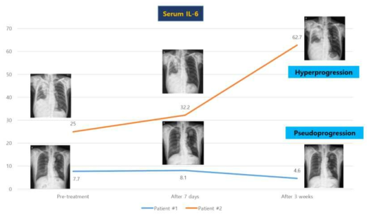 Pseudoprogression을 조기에 예측하는 사이토카인 후보물질