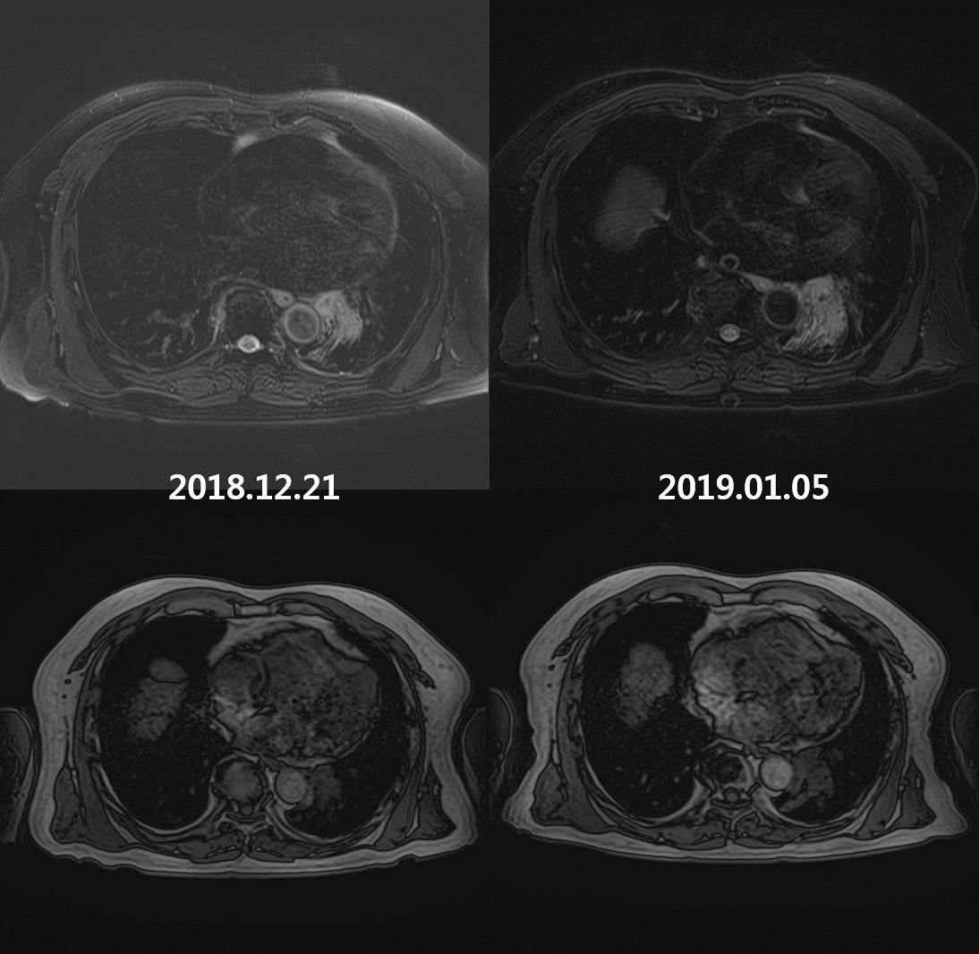 면역항암제 치료 전후 폐 자기공명영상(MRI)