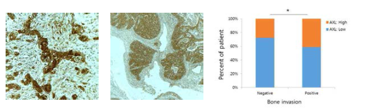 AXL 발현은 구강암 환자 뼈 침윤의 증가와 통계학적으로 유의한 상관성을 나타냄