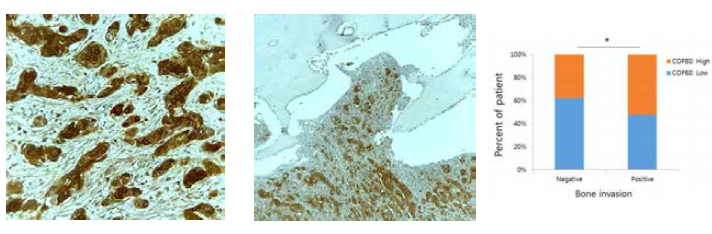 COPBII 발현은 구강암 환자 뼈 침윤의 증가와 통계학적으로 유의한 상관성을 나타냄