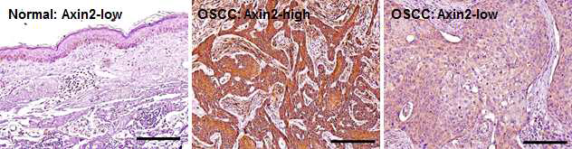 Axin2의 단백질 발현 은 구강암 환자 조직에서 정상조직에 비하여 통계학적으로 유의한 증가를 나타냄
