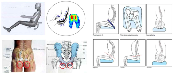 좌골 결절 부위에서의 체압 분포 형상과 골반 영향에 따른 체형 변형