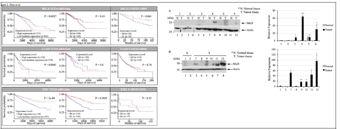 MuD 발현에 따라 유의성 있게 생존률이 변하는 것으로 선정된 암에서의 생존율 곡선. TCGA data를 R을 통하여 본 연구원이 다시 검증함. 왼쪽 박스는 교차검증을 위하여 독립적인 data에서의 생존율을 같은 방법을 이용하여 계산함. 왼쪽 western은 MuD ab를 이용하여 환자의 정상 (N)와 종양 (T) 조직에서 MuD 발현을 보여줌