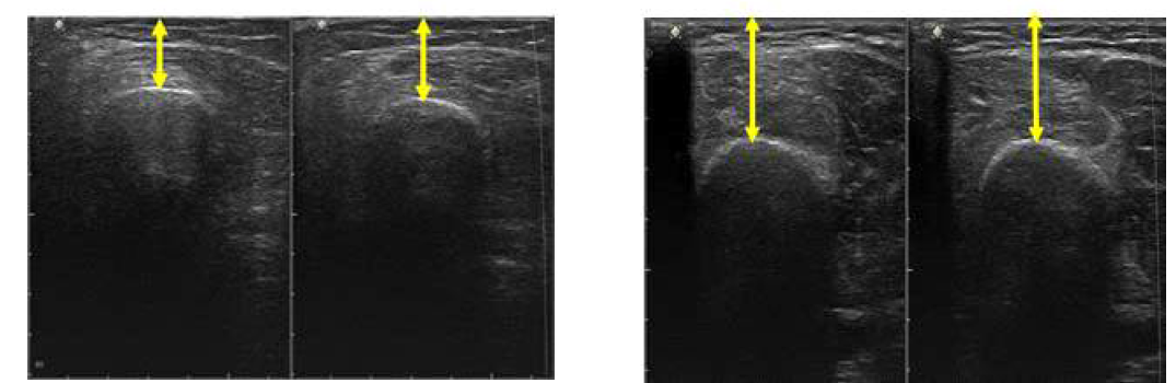 측정자가 2회 측정에 따른 근 두께 차이영상(좌), 밴드고정 2회 측정 시 근 두께의 차이(우)