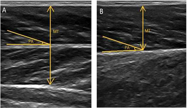 A. 전경골근(Tibialis anterior, B. 내측 비복근(Medial gastrocnemius