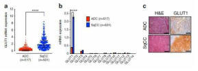 폐암의 종류 (subtype)에 따른 신진대사 특이성 (metabolic signature)