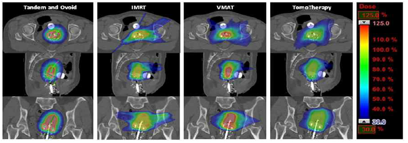 근접방사선치료, IMRT, VMAT, Tomotherapy의 선량분포