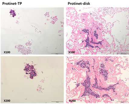 두가지 유형의 배지 (Protinel TP vs Disk)에서 편평상피암의 자라는 모습을 FFPE(Formalin fixed Paraffin embedded) H&E stain 모습. 가운데 진한 핵형 chromatin을 보이는 암세포가 뭉쳐 있음이 보임