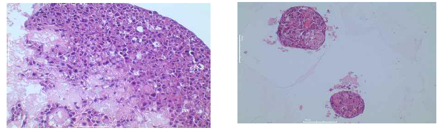 좌측: 49일째, 디스크 배양한 H2170 세포주의 H&E stain 결과. 우측: TP 지지체에 H827 세포주 배양결과. spheroid 형태로 성장함