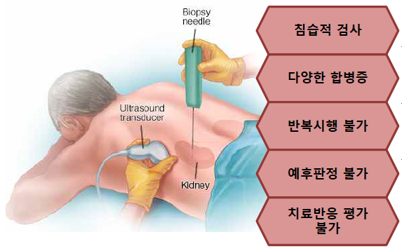 루푸스 신염 신장 조직검사의 한계