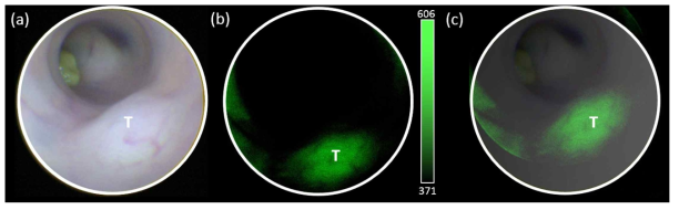 백색광 및 형광 영상의 결합. (a) 광시야 내시경으로 촬영한 마우스 정위 대장종양의 백색광 영상. (b) 녹색 형광을 방출하는 박테리아를 마우스에 정맥 주입 1일 후 광시야 내시경을 이용하여 촬영한 종양 부위에서의 형광 신호. (c) 소프트웨어를 이용하여 병합한 백색광 및 형광영상