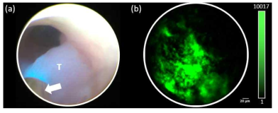 공초점 형광 내시경 시스템으로 수행한 형광 박테리아 영상. (a) 광시야 내시경으로 확인한 대장 종양 (T) 부위 에 접촉된 공초점 형광 내시경 프로브 (백색 화살표). (b) 접촉된 종양부위에서 촬영한 녹색 형광 박테리아의 영상