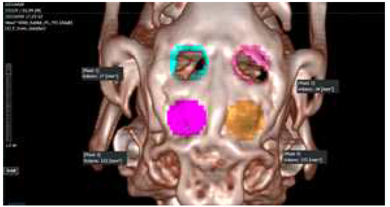 CT 촬영 및 신생골 부피분석
