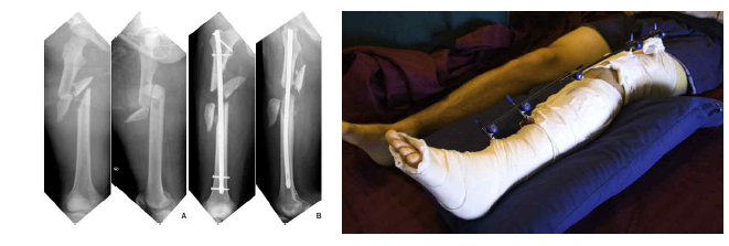 사지골절(ex. Tibial fracture)로 인한 골 결손