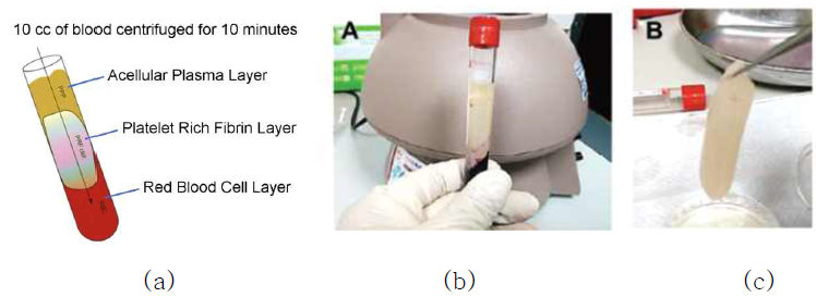 PRF preparation 과정. (a) 혈액을 centrifuge한 뒤 RBC와 PPP(platelet poor (acellular plasma) layer) 사이에서 PRF를 얻을 수 있음. (b) centrifuge한 직후의 모습. (c) PRF는 액체가 아닌 gel 형태임을 알 수 있음