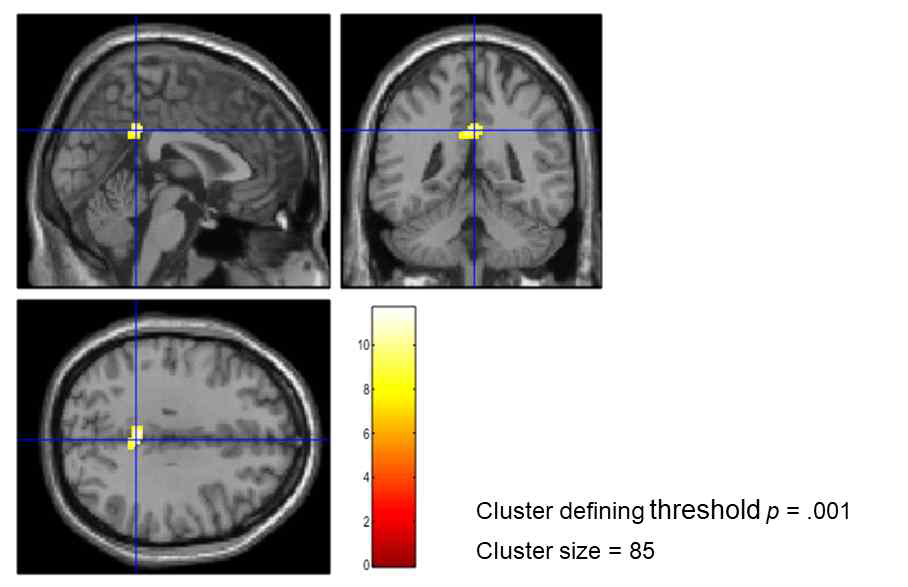 Posterior cingulate cortex (PCC) (2, -44, 32)