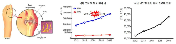 통풍결정(좌), 국내 연도별 통풍환자의 진료인원 및 진료비 현황(우)