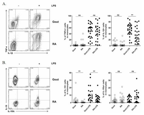 통풍환자 관절액 내의 대식세포에서 LPS 자극에 의한 염증성(A), 항-염증성 (B) 사이토카인 비교