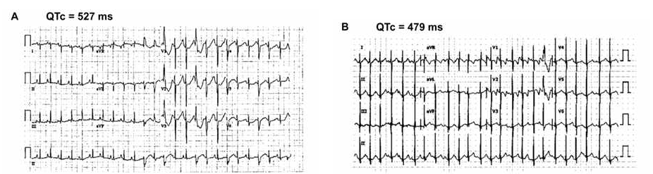 Twelve-lead Electrocardiogram (ECG) of the proband R/O LQTS. QTc는 527 ms임