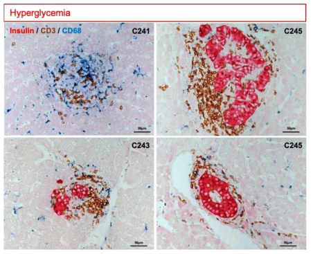 영장류 동종췌도이식의 면역조직화학법 결과. 고혈당이 나타나는 시기의 이식된 췌도 주변에는 T 세포 (Brown) 및 대식세포 (Blue)의 분포가 증가함.