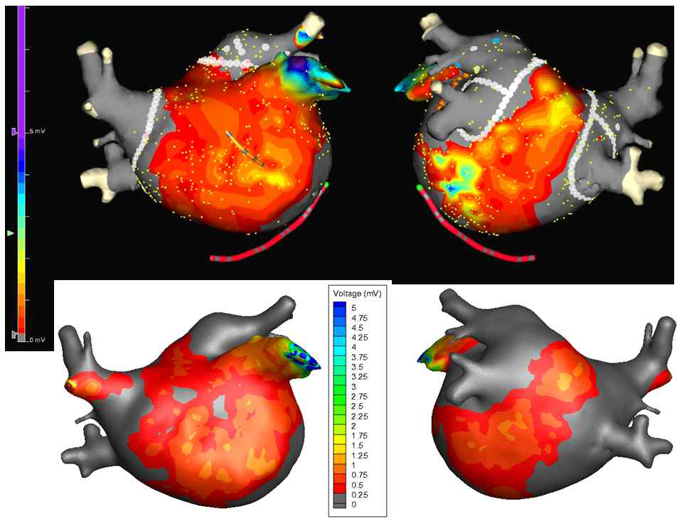 임상적으로 측정된 심장 전압 지도와 시뮬레이션 지도와의 비교