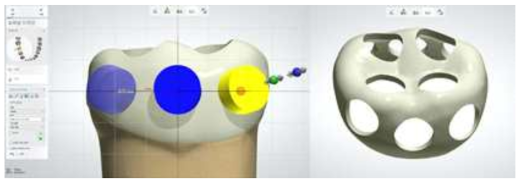 3shape design 프로그램으로 디자인한 다공성 치과보철물