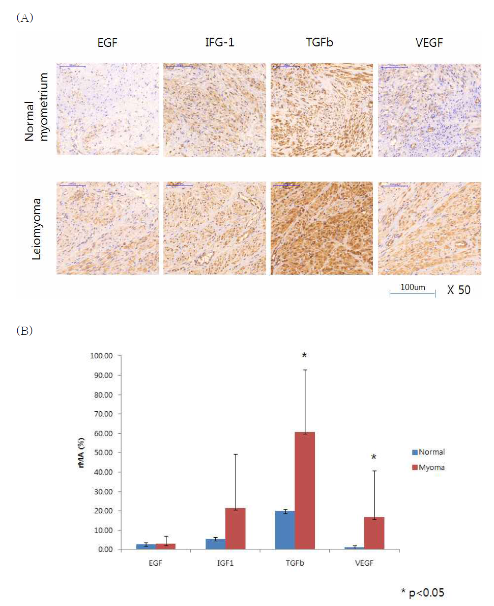 (A) Histological Expression of each growth factor (EGF, IGF-1, TGF-β and VEGF) of normal myometrium and Leiomyoma cells. Bar= 500um. (B) As a result of quantifying the expression level of GF, the expression levels of TGF-β and VEGF were significantly increased.(* P<0.05) Relative mask area: rMA=(MA/FA)×100. FA, overall field area (mm2); MA, overall mask area (mm2), which is the summed areas for each detected object in each layer