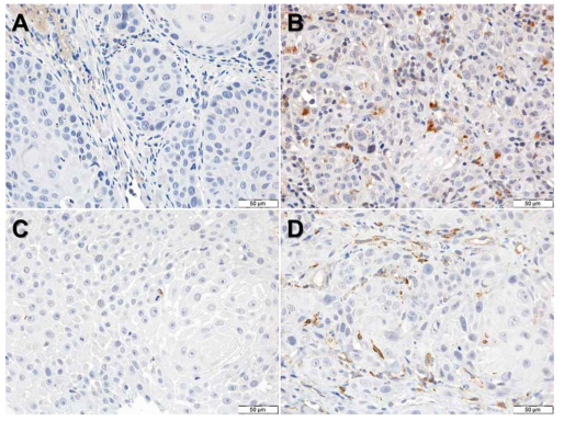 대표적 면역조직화학염색 결과(400배율). CD68 저발현(A) 및 고발현(B). Stabilin-1 저발현(C) 및 고발현(D)