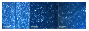 저자들의 연구 사진 : 녹내장 모델에서 stereotaxic dye injection을 통해 망막신경절세포를 retrograde labelling해보면 axoplasmic flow 차단에 의한 neurotrophic factor deprivation을 관찰할 수 있다