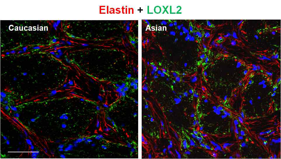 특히 세포외기질의 변화와 관련된 인자 중 lysyl oxidase-like type 2 (LOXL2)에 대한 분석에서 한국인의 사상판에서의 LOX 발현이 서양인의 사상판과 다른 점이 발견되었다 (초록색 염색)