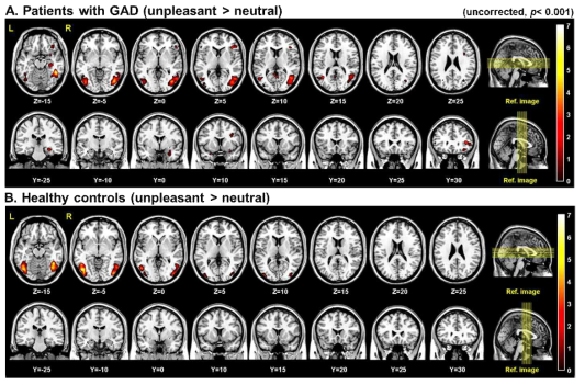 Differential brain activation patterns between patients with GAD (A) and healthy controls (B) during the working memory tasking with unpleasant and neutral distractors (uncorrected, p<0.001)