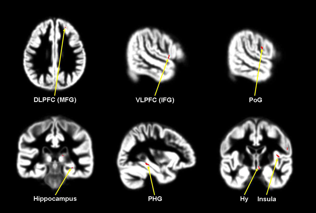 Brain areas with significant volume reduction of the gray matter in patients with GAD