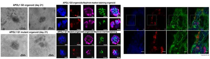 APOL1 G0, G1 유전자 변이 오가노이드 제작 및 APOL1 단백 염색 결과