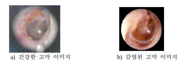 고막 이미지의 예시