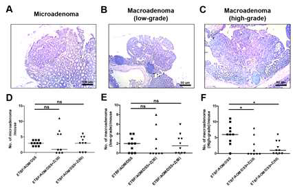 Zerumbone decreases ETBF colonization-promoted high-grade macroadenomas. FFPE colonic tissues of distal colon obtained from AOM-treated BALB/c mice infected with WT-ETBF (bft-2) and subjected to two cycles of DSS (1%) for 9 weeks were excised and stained with H&E. A representative image of microadenoma, low-grade macroadenoma, and high-grade macroadenoma is shown. Microadenoma, low-grade macroadenoma, and high-grade macroadenoma were counted for 2 H&E-stained distal colon of sections per mouse. A. Histology of microadenoma, x100 magnification. B. Histology of low-grade macroadenoma, x50 magnification. C. Histology of high-grade macroadenoma, x50 magnification. D. Formation of microadenoma. E. Formation of low-grade macroadenoma. F. Formation of high-grade macroadenoma. Z, Zerumbone. Each dot represents one mouse. Scatter plot. Horizontal bar, median. *P < 0.05. ns, no statistical significance