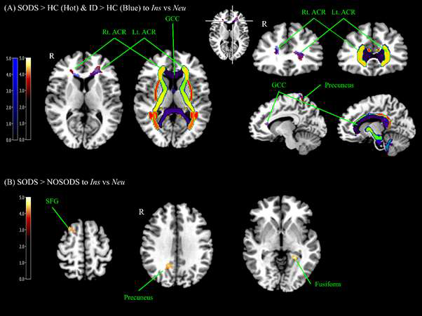 Brain areas showing increased BOLD signals in the contrast of Ins vs Neu among groups