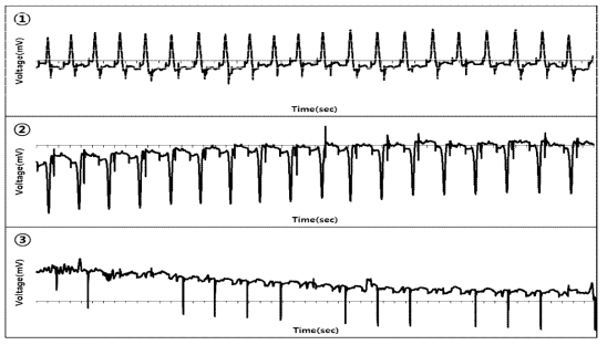 전극 위치에 따른 ECG 파형 분석(➀RA(+), LA(-), LV(ref), ➁RA(+), LA(-), LV(ref), ➂RA(+), LA(-), LV(ref))