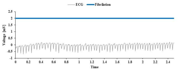 심층 신경망에 의한 Fibrillation(세동) 판정