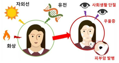 백반증 발병 원인 및 피해