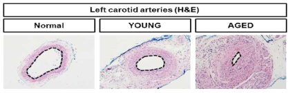 노화정도가 다른 지방줄기세포 분비 배양액을 의인성 동맥경화 동물모델에 이식 28일 후 경동맥 내강의 비교