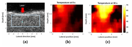 심방세동 광열치료시 초음파 온도 모니터링 (a) 초음파 영상 (b) 초음파 열화상 (치료 5초후) (c) 초음파 열화상 (치료 30초후)