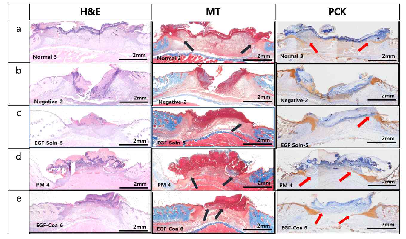 상처부위를 Hematoxylin and eosin (H&E), Masson’’s trichrome (MT) 및 pan-cytokeratin (PCK) staining으로 염색한 Histological images. (a) 정상 마우스, (b) Negative (diabetic mice) treated with PBS로만 투여한 당뇨 마우스 (negative), (c), (d), and (e) Diabetic mice treated with EGF solution, EGF-PM, 및 EGF-Coa로 투여한 당뇨 마우스. Black (MT) 과 red (PCK) 화살표는 각각 새롭게 형성된 granulation을 따라 keratinocytes의 수평 이동을 나타냄