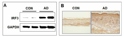 아토피피부염에서 IRF3의 연관성 확인. A. 사람 피부조직에서 IRF3의 발현. B. 아토피피부염 마우스모델에서 IRF3 발현