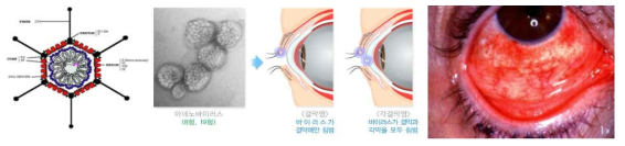 아데노바이러스에 의한 유행성각결막염(Epidemic keratoconjunctivitis)